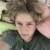 Acne ;-;